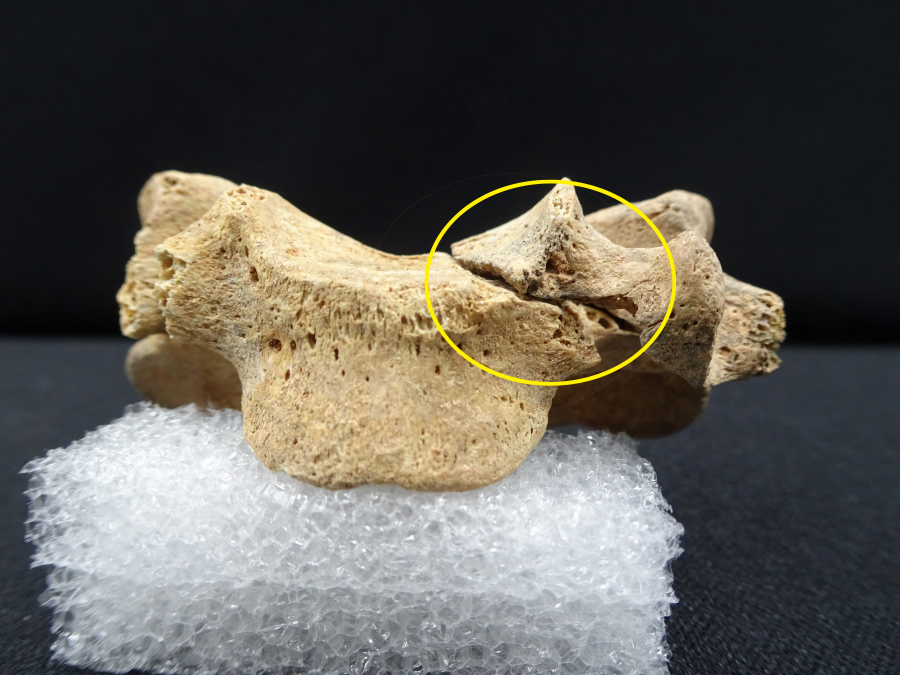 5호 유해(복자 윤지충 바오로)의 다섯째 목뼈에서 사망 무렵 예기 손상 모습